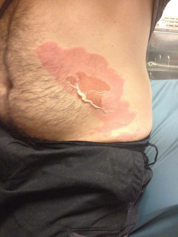 Cassie's husband, Mark, received a deep burn to the stomach. Photo / Facebook / Cassie Hodges